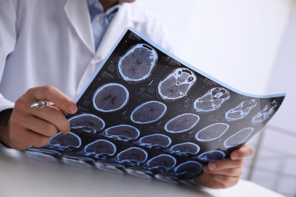 Understanding Traumatic Brain Injuries And Their Legal Consequences